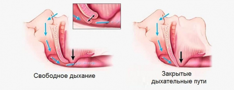 Хирургическое лечение храпа и СОАС