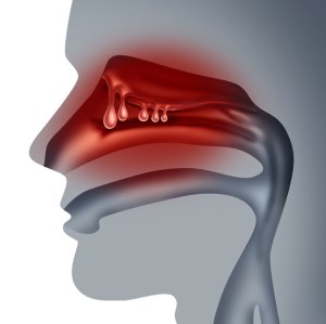 Полипозный риносинусит Полипозный риносинусит