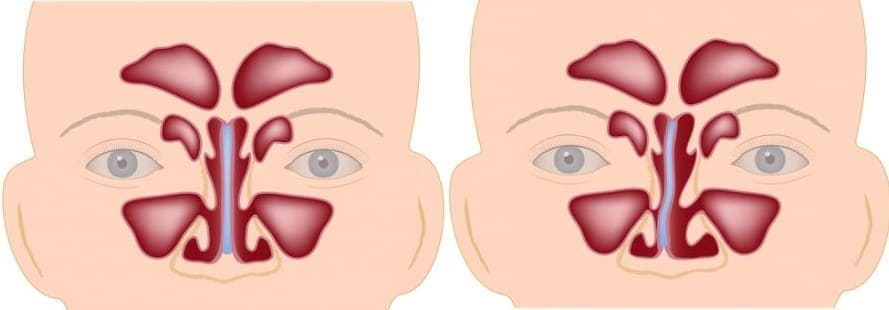Функциональная ринопластика Функциональная ринопластика