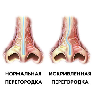 Септопластика — операция по исправлению перегородки носа Септопластика — операция по исправлению перегородки носа